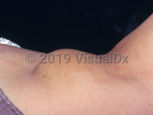 Clinical image of Accessory breast tissue - imageId=2799551. Click to open in gallery. 