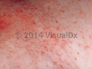 Clinical image of Langerhans cell histiocytosis - imageId=280377. Click to open in gallery.  caption: 'A close-up of showers of erythematous and purpuric macules and papules.'
