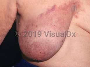 Clinical image of Cutaneous presentations of breast cancer