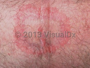 Clinical image of Lyme disease