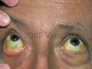 Clinical image of Drug-induced jaundice - imageId=2808199. Click to open in gallery.  caption: 'Deep yellow color of the sclerae.'