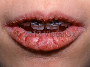 Clinical image of Cheilitis - imageId=2817180. Click to open in gallery.  caption: 'Cracked, eroded, and crusted plaques on the lips.'