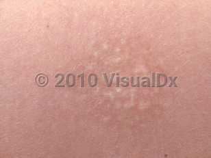 Clinical image of Alopecia mucinosa - imageId=2831863. Click to open in gallery.  caption: 'A close-up of a faint red-brown plaque displaying whitish follicularly-based papules.'