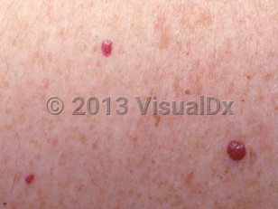 Clinical image of Cherry hemangioma - imageId=2832972. Click to open in gallery.  caption: 'A close-up of discrete red papules of varying sizes.'