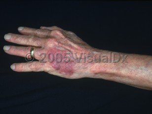 Clinical image of Solar purpura - imageId=2834784. Click to open in gallery.  caption: 'A purpuric patch on the dorsal hand. '