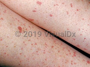 Clinical image of Immune thrombocytopenic purpura - imageId=2835942. Click to open in gallery.  caption: 'Many petechial macules and patches on the legs.'