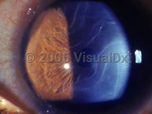 Clinical image of Congenital glaucoma - imageId=2840357. Click to open in gallery.  caption: '<span>Haab's striae are swirly breaks in Descemet's membrane in congenital glaucoma.</span>'