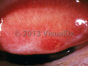 Clinical image of Trachoma - imageId=2841515. Click to open in gallery.  caption: 'White scarring of the conjunctiva secondary to trachoma.'