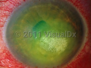Clinical image of Drug-induced corneal deposits - imageId=2841676. Click to open in gallery.  caption: 'A green-white corneal deposit secondary to ciprofloxacin drops.'