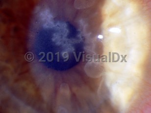Clinical image of Herpes simplex virus keratitis - imageId=2842477. Click to open in gallery.  caption: 'A dendritic corneal ulcer.'