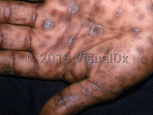 Clinical image of Secondary syphilis