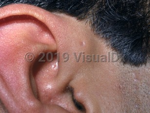 Clinical image of Preauricular sinus