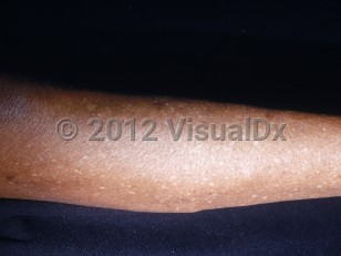 Clinical image of Idiopathic guttate hypomelanosis - imageId=2860340. Click to open in gallery.  caption: 'Numerous hypopigmented macules on the leg.'