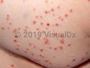 Clinical image of Pityriasis lichenoides et varioliformis acuta - imageId=2861923. Click to open in gallery.  caption: 'Many erythematous papules, some with overlying hemorrhagic crusting, on the buttocks.'