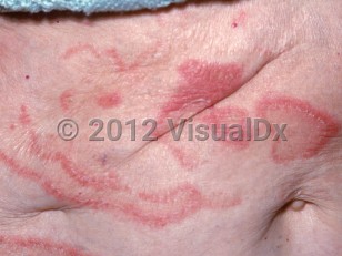 Clinical image of Erythema gyratum repens - imageId=2863184. Click to open in gallery. 