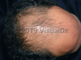Clinical image of Male pattern alopecia - imageId=2863495. Click to open in gallery.  caption: 'Extensive thinning of hair over the frontal scalp.'