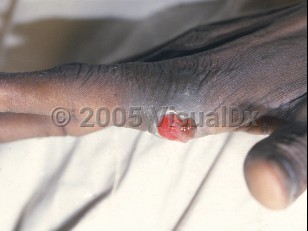 Clinical image of Bacillary angiomatosis - imageId=2864995. Click to open in gallery.  caption: 'An eroded nodule with a macerated collarette of scale at its base, on the finger of an HIV-positive patient.'