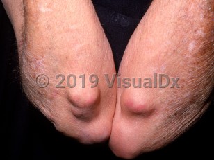 Clinical image of Rheumatoid nodule - imageId=2870478. Click to open in gallery.  caption: 'Numerous pink and skin-colored nodules, of varying sizes, over the elbows.'