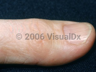 Clinical image of Longitudinal nail ridging