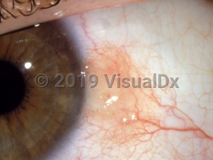 Clinical image of Conjunctival nevus - imageId=2889663. Click to open in gallery.  caption: 'Tiny brown papule on the bulbar conjunctiva.'