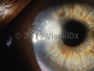 Clinical image of Fungal corneal ulcer - imageId=2891581. Click to open in gallery. 