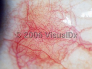 Clinical image of Diffuse episcleritis - imageId=2892296. Click to open in gallery. 