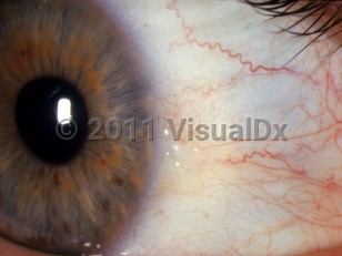 Clinical image of Pinguecula - imageId=2892787. Click to open in gallery. 