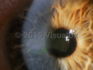 Clinical image of Recurrent corneal erosion - imageId=2892800. Click to open in gallery. 