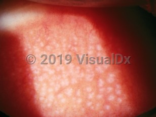 Clinical image of Giant papillary conjunctivitis