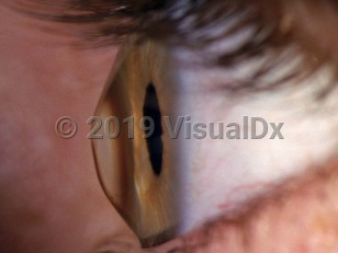 Clinical image of Keratoconus - imageId=2894408. Click to open in gallery. 