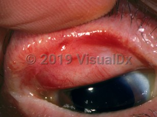 Clinical image of Cicatricial conjunctivitis - imageId=2906310. Click to open in gallery.  caption: 'Bulbar conjunctival chemosis, telangiectasia, and scarring.'