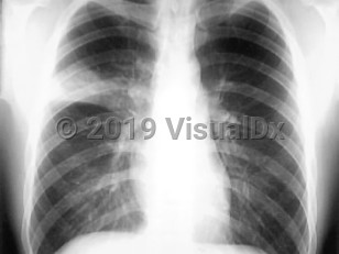 Imaging Studies image of SARS - imageId=2907342. Click to open in gallery.  caption: 'Chest x-ray on day 5 of illness showing right-upper lobe infiltrates.'