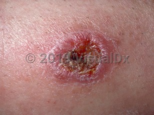Clinical image of New World cutaneous leishmaniasis - imageId=290962. Click to open in gallery.  caption: 'Close-up of a dull pink, scaly plaque with a central crusted ulcer.'