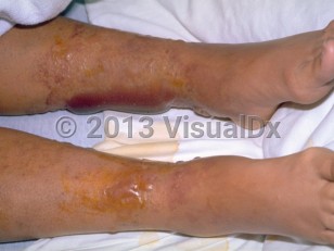 Clinical image of Vibrio vulnificus infection - imageId=291036. Click to open in gallery.  caption: 'Several vesicles and large bullae, some hemorrhagic, with surrounding purpura on the legs.'