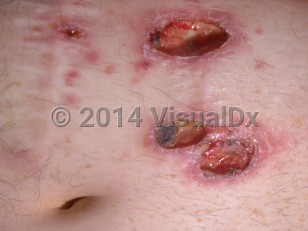 Clinical image of Cutaneous amebiasis - imageId=291077. Click to open in gallery.  caption: 'A close-up of deep ulcers with purulent bases and overlying crusting in areas developing near a surgical scar.'