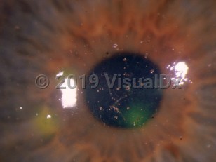 Clinical image of Corneal abrasion