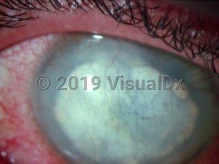Clinical image of Lipid keratopathy - imageId=2913037. Click to open in gallery.  caption: 'A cream-to-white discoloration in the corneal stroma interspersed with fine blood vessels.'