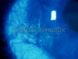 Clinical image of Corneoconjunctival intraepithelial neoplasia - imageId=2915964. Click to open in gallery. 