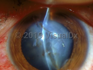 Clinical image of Corneal laceration - imageId=2916608. Click to open in gallery. 