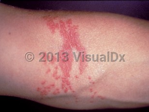 Clinical image of Jellyfish sting - imageId=292160. Click to open in gallery.  caption: 'Edematous, erythematous papules and plaques in linear arrays at the antecubital fossa following a lion's mane jellyfish sting.'