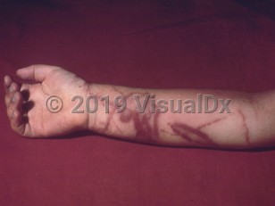 Clinical image of Hawaiian box jellyfish sting - imageId=292476. Click to open in gallery.  caption: 'Linear and wavy, deeply violaceous plaques on the arm following a box jellyfish sting.'