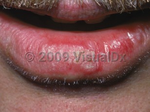 Clinical image of Actinic cheilitis - imageId=2929233. Click to open in gallery.  caption: 'Scaly, white, and erythematous plaques on the lower lip.'