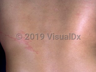 Clinical image of Gnathostomiasis - imageId=292998. Click to open in gallery.  caption: 'A serpiginous pink plaque on the back.'