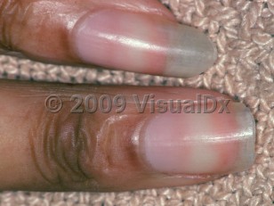 Clinical image of Nail changes of chronic renal failure