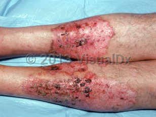 Clinical image of Bowel-associated dermatosis-arthritis syndrome