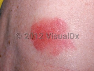 Clinical image of Bumblebee sting - imageId=2936113. Click to open in gallery.  caption: 'A close-up of an urticarial plaque with a central punctum.'