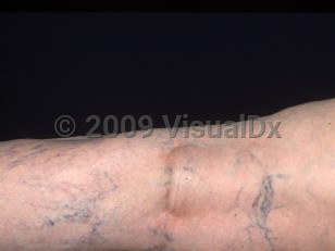 Clinical image of Varicosities - imageId=2937223. Click to open in gallery.  caption: 'A background of ropey blue-green veins and superficial thinner linear and tangled purple veins (spider veins and reticular veins) on the posterior leg.'
