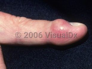 Clinical image of Giant cell tumor of tendon sheath - imageId=2948899. Click to open in gallery.  caption: 'A smooth reddish and yellowish nodule with overlying telangiectasias on the distal finger.'