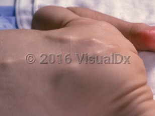 Clinical image of Failure to thrive syndrome - imageId=2951580. Click to open in gallery.  caption: 'Underweight child secondary to neglect.'