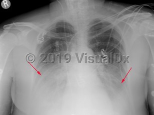 Imaging Studies image of Legionellosis - imageId=2954652. Click to open in gallery.  caption: 'Frontal chest x-ray with opacities in the bilateral lower lobes in this patient with Legionnaires' disease.'